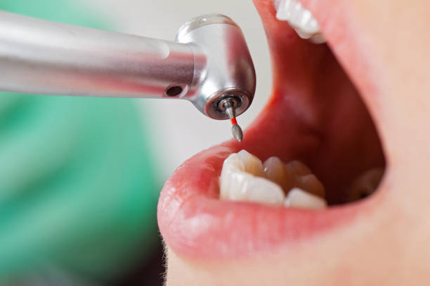 Best Emergency Dentist for Lost Fillings or Crowns in New Berlinville, PA